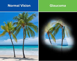 Glaucoma is a progressive vision condition that can lead to permanent blindness. Glaucoma Causes Symptoms Treatments Acuity Eye Group