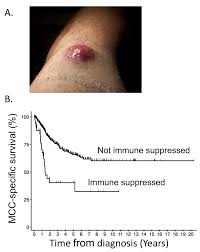 Find everything about what is merkel skin cancer and start saving now. Decreased Merkel Cell Carcinoma Survival In Immune Suppressed Individuals