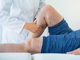 Blood clot in a leg is symptomatic approach of deep vein thrombosis. Deep Vein Thrombosis Definition Symptoms And Treatment