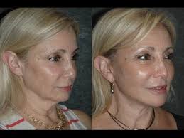 Local Anesthesia Neck Lift Before And After 59 Year Old With Turkey Neck And Jowls Neck Lift Face Lift Surgery Neck Lift Surgery