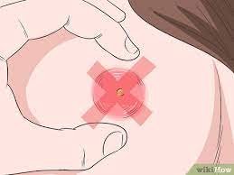 How To Get Rid Of An Abscess: 12 Steps (With Pictures) - Wikihow