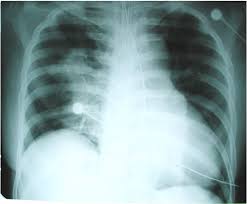 Image result for Pulmonary Contusion