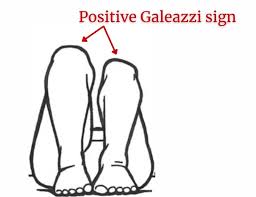 Image result for Galeazzi Sign