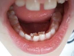 Pin On Teeth