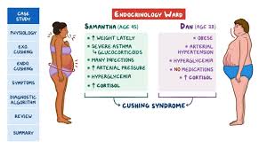 Cushing Syndrome And Cushing Disease Pathology Review Video Explanation Osmosis