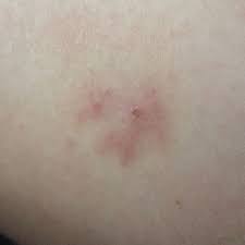 Nicht jeder zeckenbiss zieht allerdings eine solche infektion nach sich. Zeckenbiss Damit Zum Arzt Krankheit Blut Parasiten