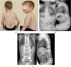 Image result for Spinal Dysraphism