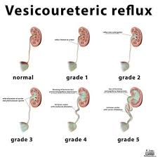 This is called vesicoureteral reflux or vur. Gu Flashcards Quizlet