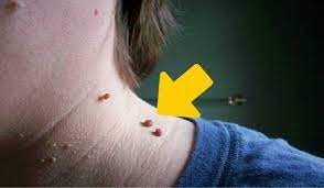 6 consejos para eliminar naturalmente los acrocordones mejor con salud como quitar verrugas eliminar las verrugas verrugas en el cuello