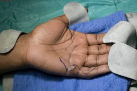 Instead of sliding out the lcd you have to pop it out of a housing. Digital Nerve Repair Autograft Using Medial Cutaneous Nerve Of Forearm Surgical Technique Orthoracle