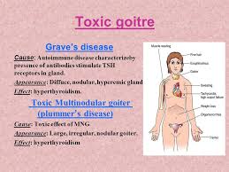 Toxic nodular goiter (tng) or plummer disease is a medical condition where the gland has developed nodule or adenoma in it. Benign Thyroid Disorders Ppt Video Online Download