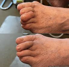 Image result for toe amputation