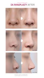 Da S Line Rhinoplasty Before And After Da Patients Everyone Has A Unique Nose So Depending On Y Rhinoplasty Rhinoplasty Before And After Nose Plastic Surgery