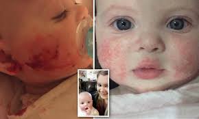 What other treatments are available? Brisbane Baby With Severe Eczema On Her Face Told She Ll Have To Wait A Year For Treatment Daily Mail Online