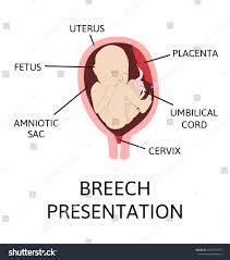 Image result for Breech Presentation