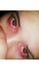 Eyes turn red and puffy due to cannabinoids in marijuana such as thc. Killing Eyes