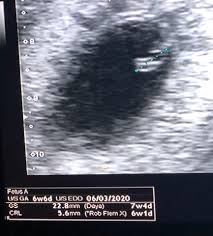 The aims of this scan are to determine the number of embryos present and whether the pregnancy is progressing normally inside the uterus. Life Unexpected Nhs Dating Scan 6 Weeks Pregnant