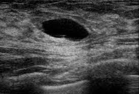 How often does inflammatory breast cancer occur (ibc)? Inflammatory Breast Disease Mastitis Cysts Teachmesurgery