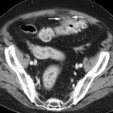 Also, a woman who undergoes ultrasound and/or mri imaging can request a disk with the images on them and get a second opinion if there. Multi Slice Spiral Ct In Routine Diagnosis Of Suspected Acute Left Sided Colonic Diverticulitis A Prospective Study Of 120 Patients Springerlink