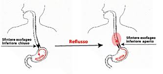 Vanno evitati tutti quegli alimenti o bevande che possono aumentare la secrezione gastrica di acido. Studio Dott Carrara Reflusso Gastrico E Alimentazione