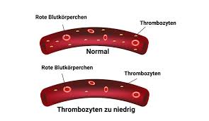 Trombozyten spielen bei der (свертывании крови) eine wichtige rolle. Thrombozytopenie Zu Wenige Blutplattchen Praktischarzt
