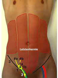 Leistenbruch Op In Nurnberg Klinik Hallerwiese De