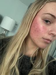 Does anyone with Lyme also have EHS? (Electromagnetic HyperSensitivity)