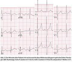 Ekg Interpretation Was Ist Bei Kindern Anders Doctors Today