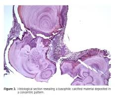 Image result for Sialolithiasis
