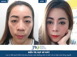 Các vị bằng tiếng anh. 5 Nguyen Nhan Gay Sá»¥p Mi Máº¯t Va Cach Ä'iá»u Trá»‹ Hiá»‡u Quáº£ Nháº¥t