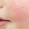 A psoríase invertida, também conhecida como psoríase inversa, é um tipo de psoríase que provoca o surgimento de manchas vermelhas na pele, especialmente na região das dobras, mas que. Https Encrypted Tbn0 Gstatic Com Images Q Tbn And9gcsklqb Ws5o12keisgiev1dodmjqiv2upohh6ix77mfsav3yc70 Usqp Cau