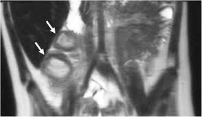 Image result for Neutropenic Colitis