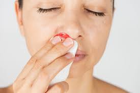 Is My Nose Bleed An Emergency Kingwood Emergency Hospital