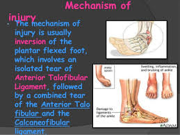 563 fracture, sprain, strain and dislocation except femur, hip, pelvis and thigh without mcc; High Grade Tear Of Anterior Talofibular Ligament Productssupernal