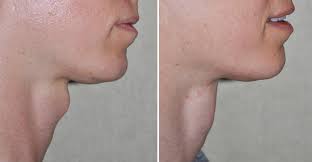 If you ask about the origins of adam's apple, you will get an exciting story. Tracheal Shave Adam S Apple Reduction For Neck Contouring Explore Plastic Surgery