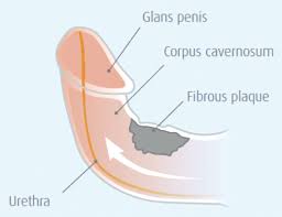 As we get older, these enzymes decrease and wounds leave bigger scars. Racgp Peyronie S Disease Watch Out For The Bend