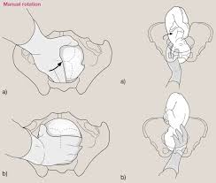 Image result for Manual Rotation in Occipitoposterior Presentation