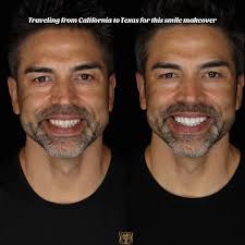 Eddie Judge New Teeth