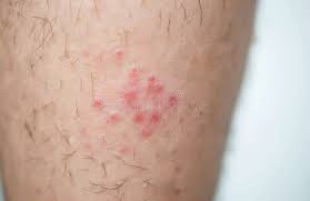 Image result for allergy rash on the legs