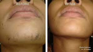 Laser hair removal before and after. Celina S Laser Hair Removal Laser Hair Removal Ny