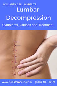 Spine Surgery For Lumbar Decompression Stem Cell Therapy Lumbar Decompression Cell Therapy