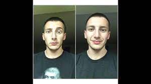 To date, it remains a clinical diagnosis of exclusion. Bell S Palsy Recovery Youtube