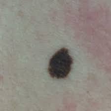 There are a number of different treatments doctors recommend. Melanoma The Most Dangerous Type Of Skin Cancer