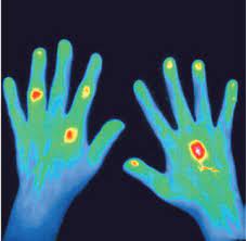 Untersuchungen Diagnose Rheumatoide Arthritis Krankheiten Internisten Im Netz