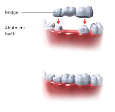 Maybe you would like to learn more about one of these? Pemasangan Gigi Palsu Fungsi Prosedur Dan Perawatan Idn Medis