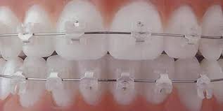 How much braces cost and how to save. Beautiful Beautiful Braces Get The Smile You Have Been Dreaming Of At Y2k Dentistry Www Y2kdentistry Net Dental Braces Teeth Braces Orthodontics Braces