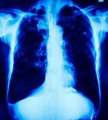 Check spelling or type a new query. Pneumothorax In Rontgen Thorax Zu Sehen Die Drainage Zu Intercostral Wollen Lizenzfreie Fotos Bilder Und Stock Fotografie Image 53112463