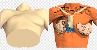 Trichterbrust / kielbrust mit fehlen oder unterentwicklung eines brustmuskels. Poland Syndrome Pectus Excavatum Surgery Thorax 3d Women Tshirt Woman Arm Png Pngwing