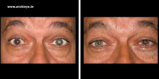 Cataract Surgery Before And After Cataract Surgery Cataract Surgery