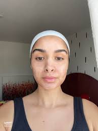 Fractional CO2 Laser Day 4